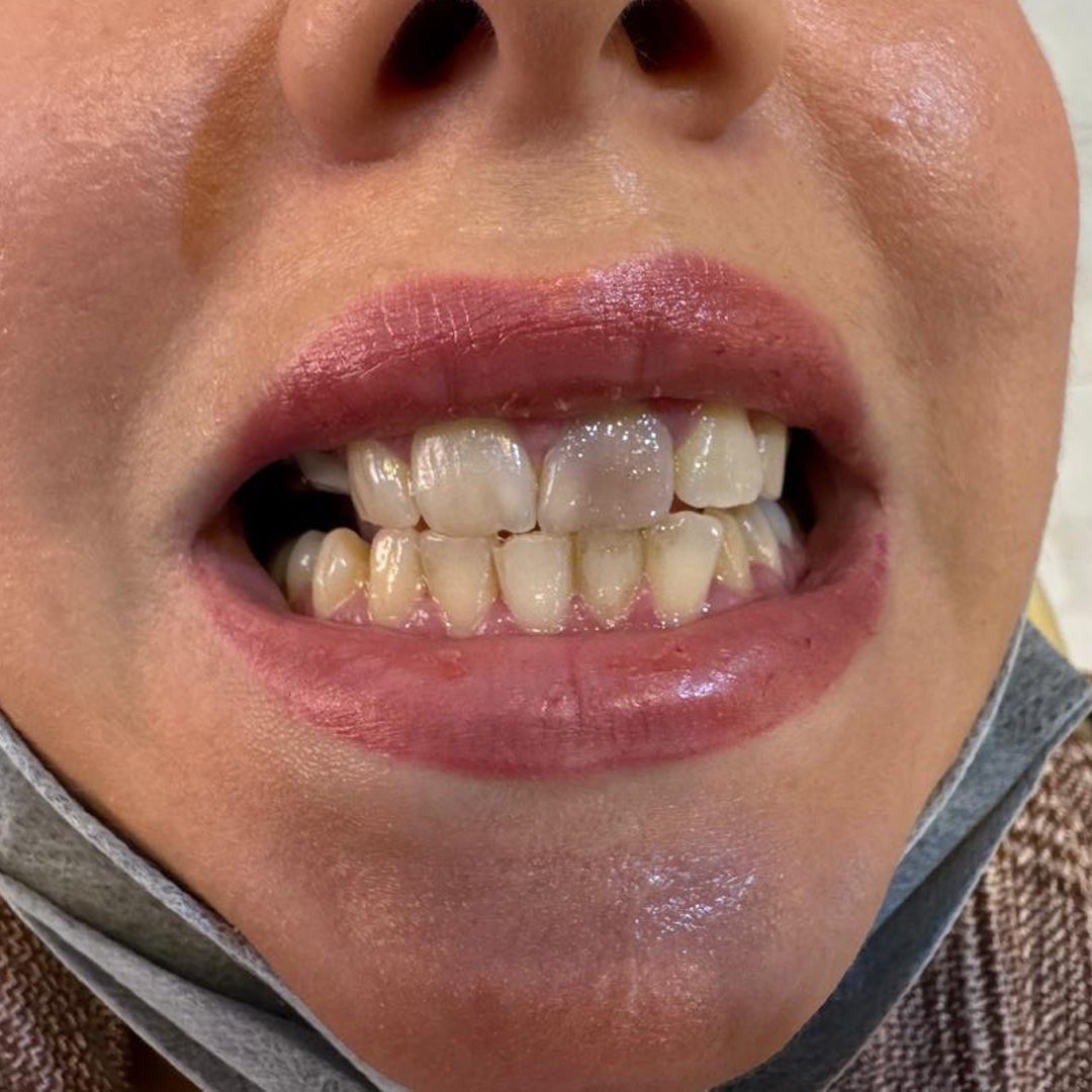 Digital-smile-design-before قبل طراحی لبخند دیجیتال