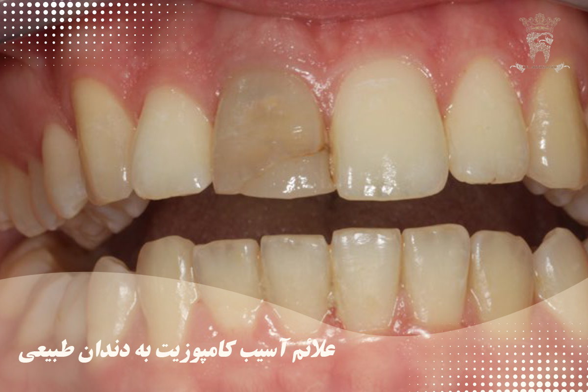 آسیب کامپوزیت به دندان: دلایل و روشهای پیشگیری 1 علائم آسیب کامپوزیت به دندان طبیعی