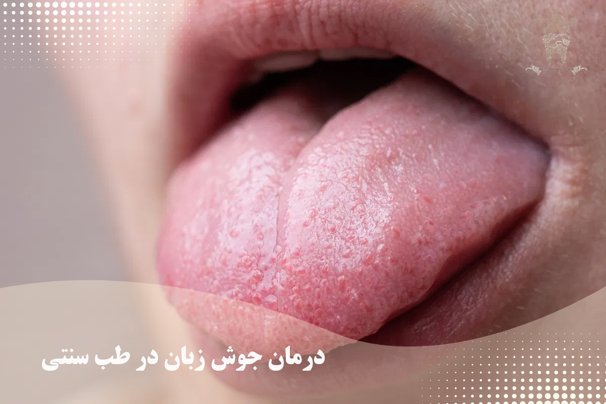 جوش داخل دهان و روشهای درمان آن 10 درمان جوش زبان در طب سنتی