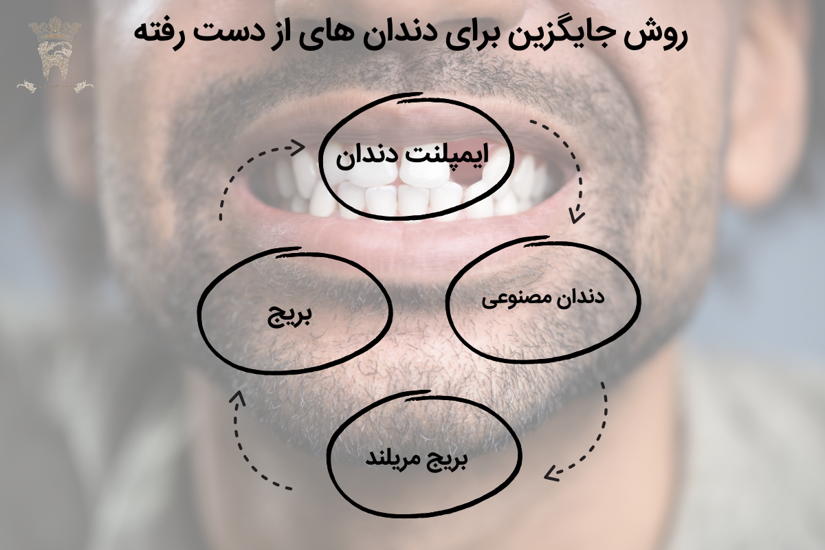 روکش دندان بدون پایه: قیمت و مزایای آن 1 روش جایگزین برای دندان های از دست رفته