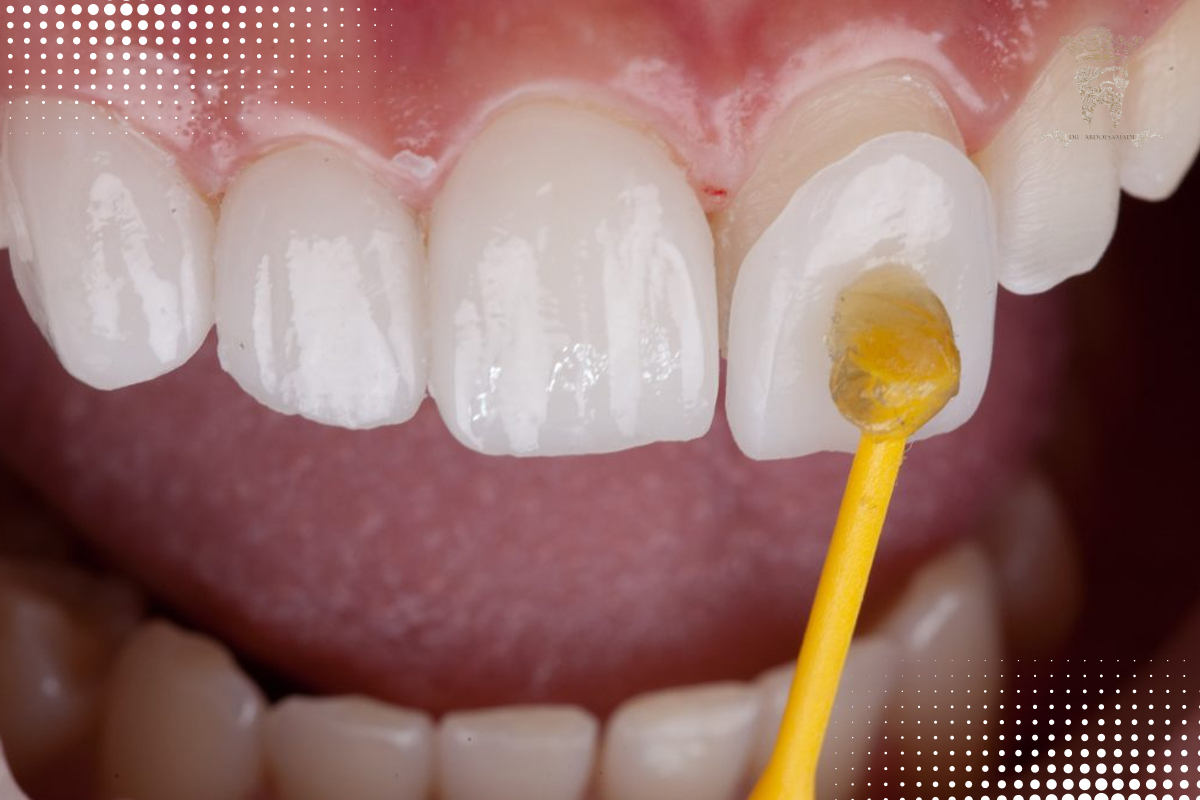 دلایل افتادن لمینت دندان بررسی علل و جلوگیری از آن 1 خطاهای رایج در نصب لمینت دندان