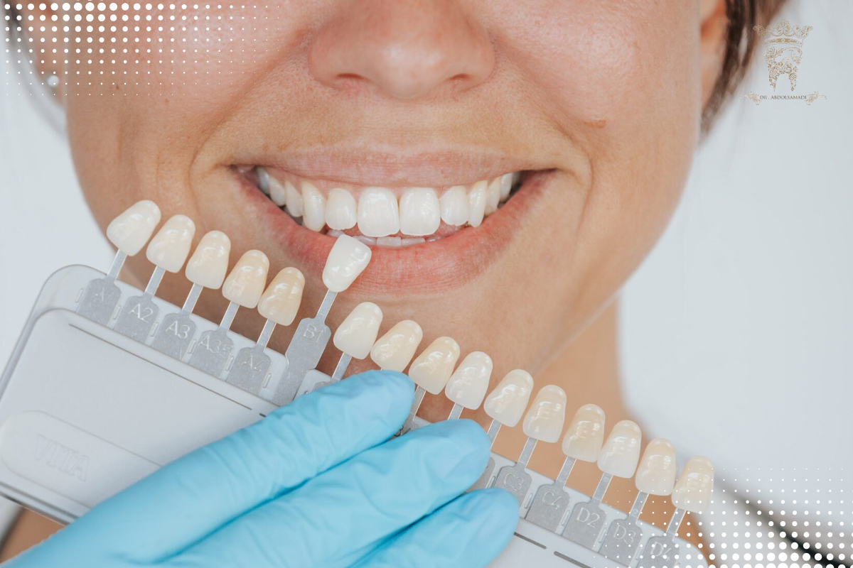 دلایل افتادن لمینت دندان بررسی علل و جلوگیری از آن 5 تعویض لمینت دندان