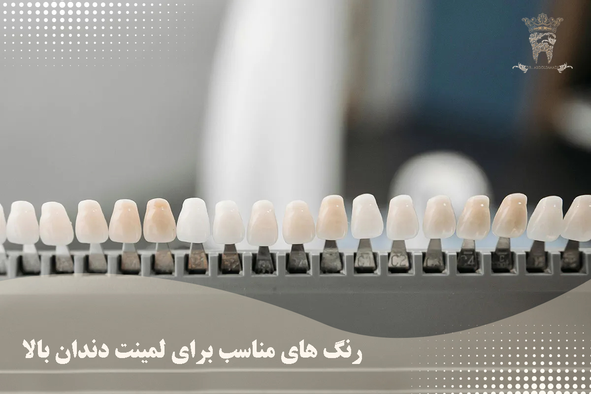 لمینت دندان بالا به چه صورت است؟ 3 رنگ های مناسب برای لمینت دندان بالا