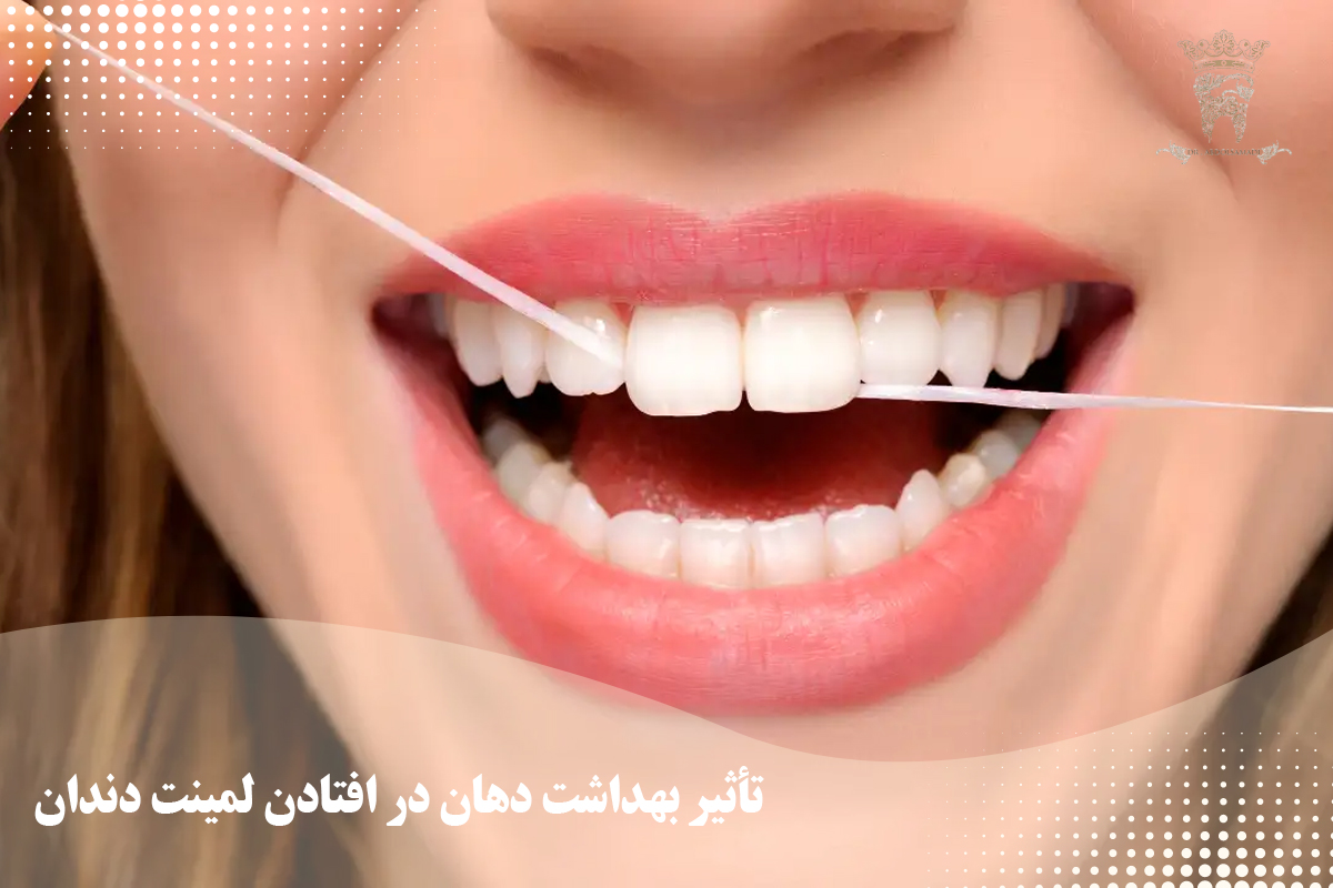 دلایل افتادن لمینت دندان بررسی علل و جلوگیری از آن 2 تأثیر رژیم غذایی و بهداشت دهان در افتادن لمینت دندان