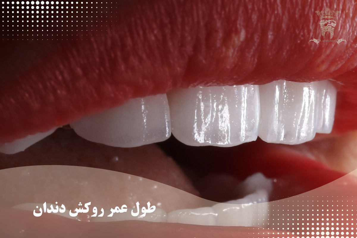 روکش دندان بدون پایه: قیمت و مزایای آن 4 طول عمر روکش دندان