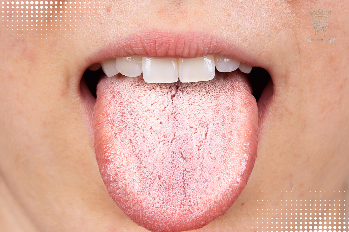 علتهای رایج سوزش لثه و روشهای پیشگیری 1 دلایل سوزش لثه