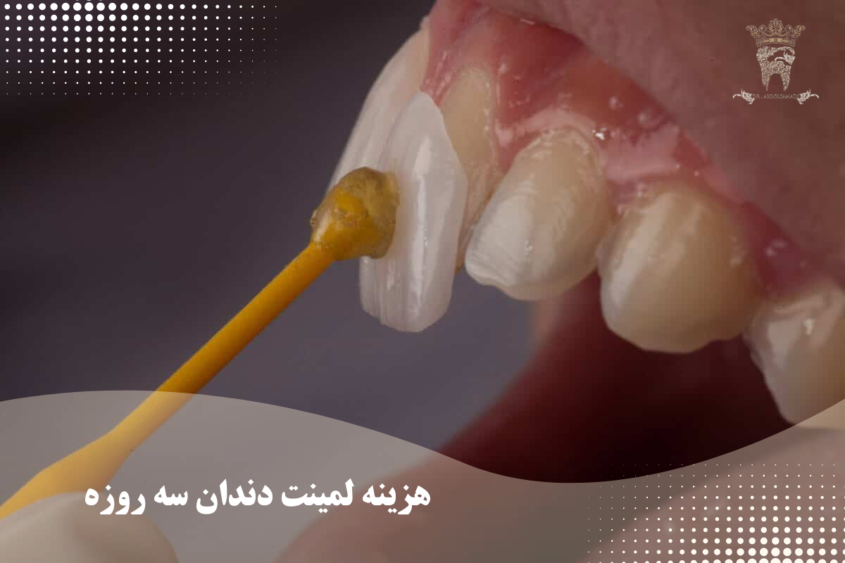 همه چیز درباره لمینت دندان سه روزه: زیبایی لبخند در کمترین زمان 4 هزینه لمینت دندان سه روزه