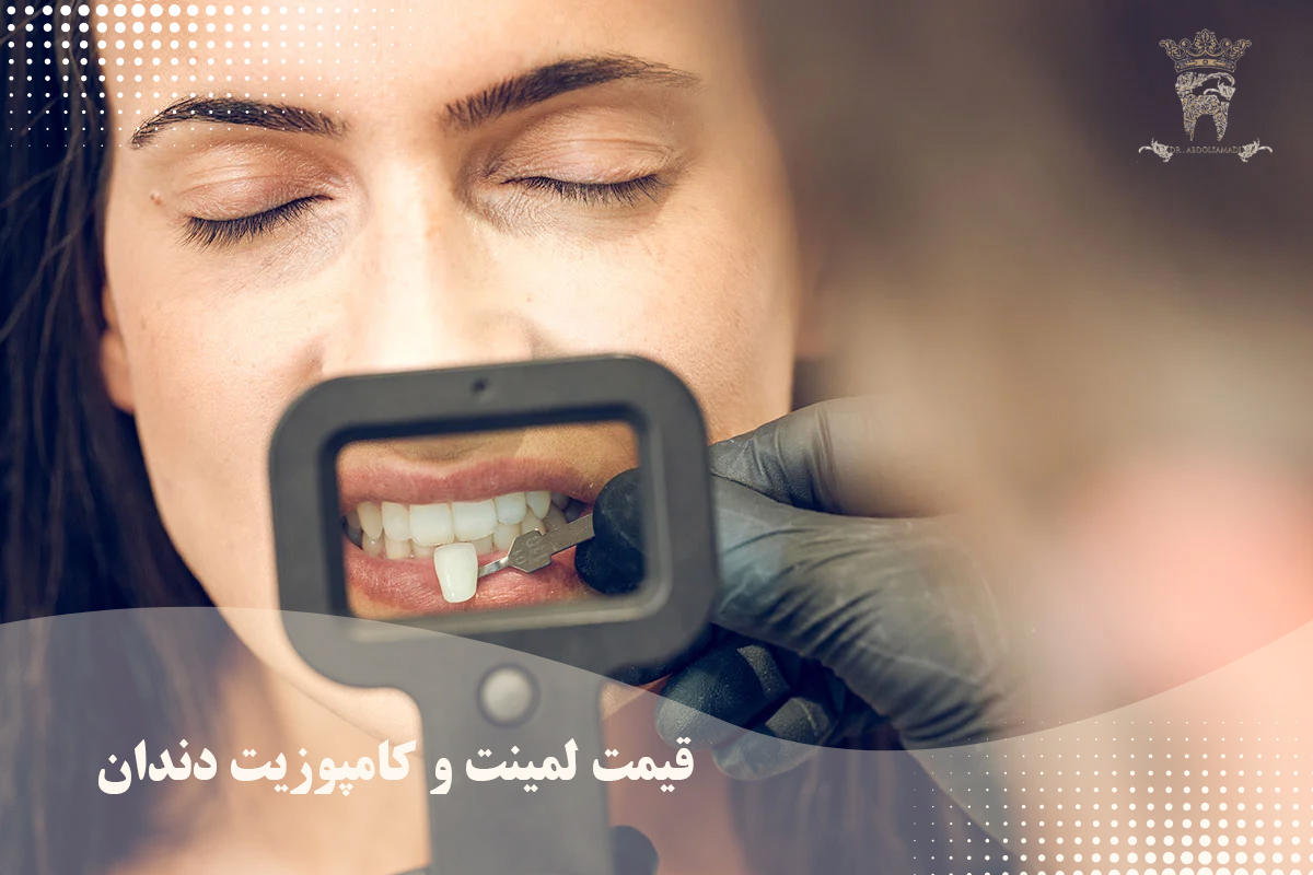 دانستنیهایی درباره تفاوت کیفیت لمینت و کامپوزیت دندان 4 قیمت لمینت و کامپوزیت دندان