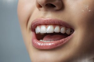 تفاوت کیفیت لمینت و کامپوزیت دندان