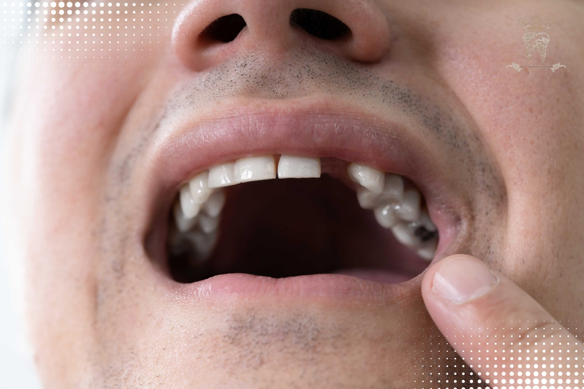 لمینت دندان فوری (لمینت دندان یک روزه) 8 محدودیتها و موارد منع استفاده از لمینت فوری