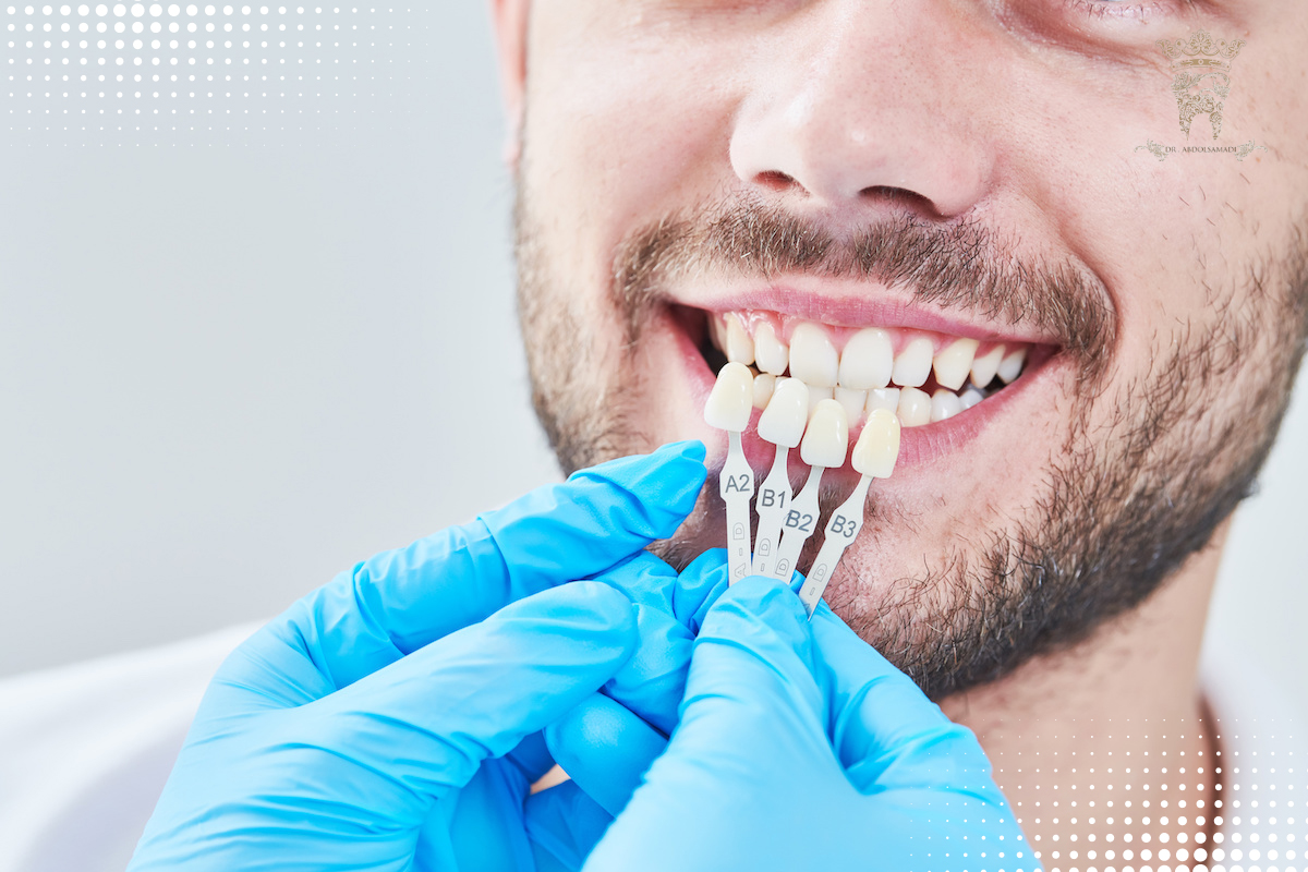 لمینت متحرک دندان؛ مزایا و قیمت خرید 3 Steps to install removable dental laminate