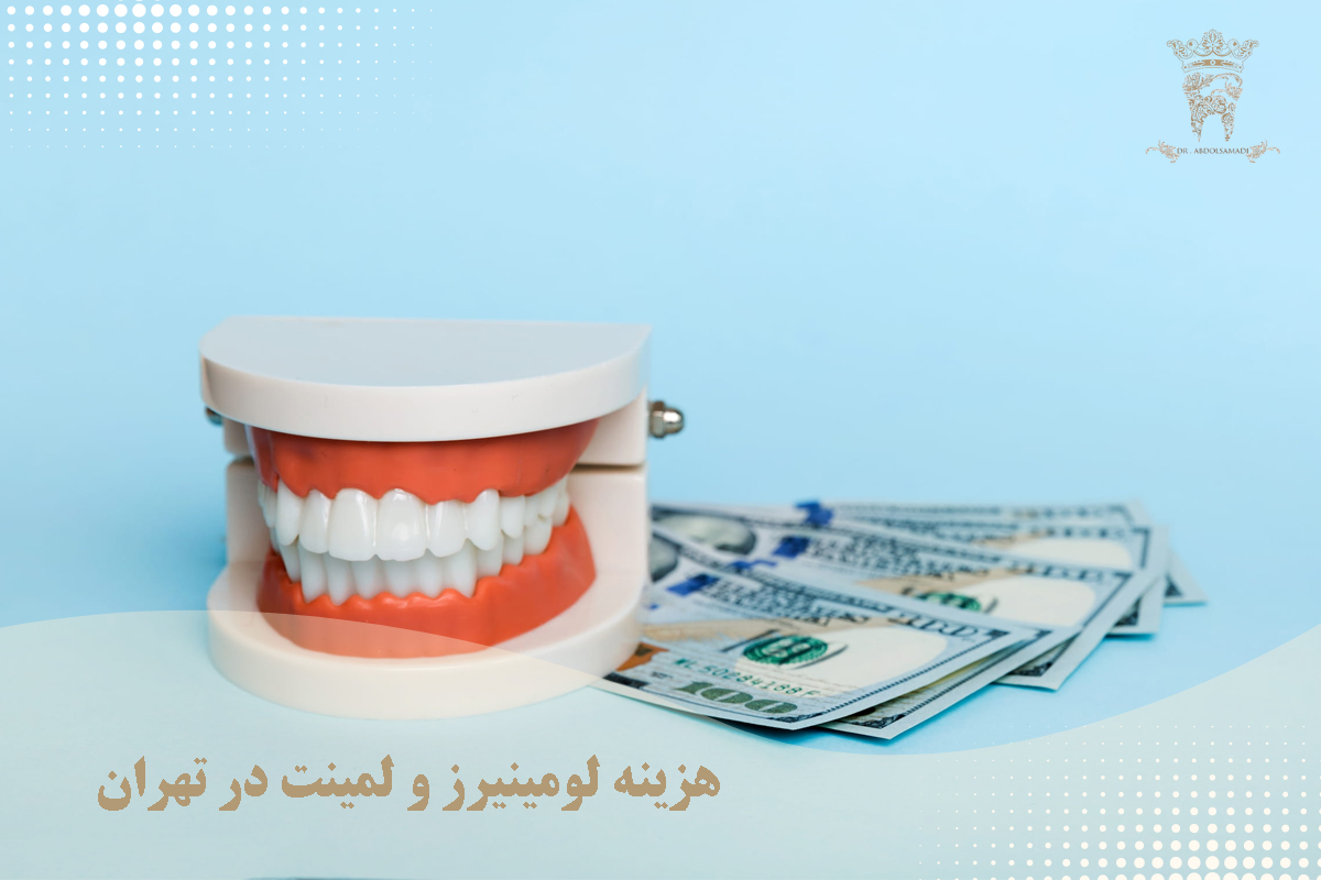 لومینیرز و لمینت دندان: آیا لومینیرز همان لمینت دندان است؟ 5 هزینه لومینیرز و لمینت در تهران