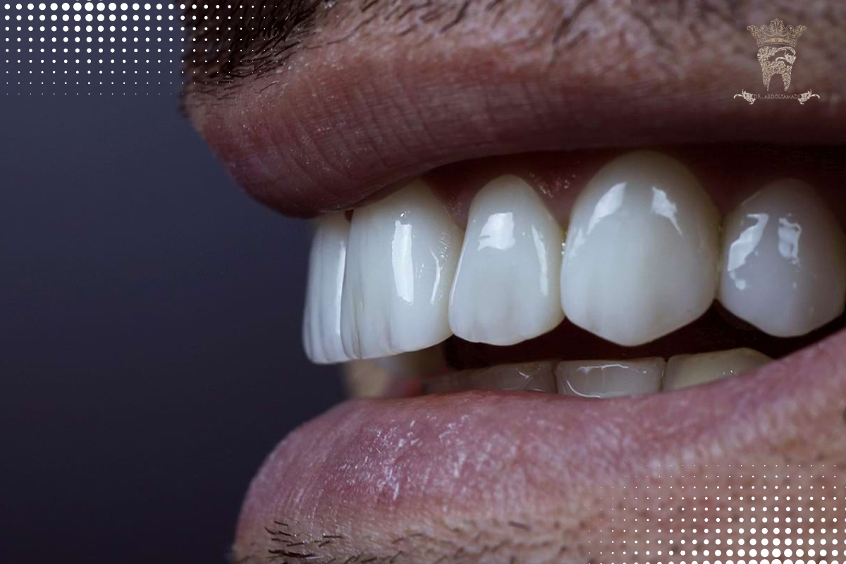 معرفی انواع لمینت دندان سرامیکی و کاربرد آنها 6 عمر لمینت