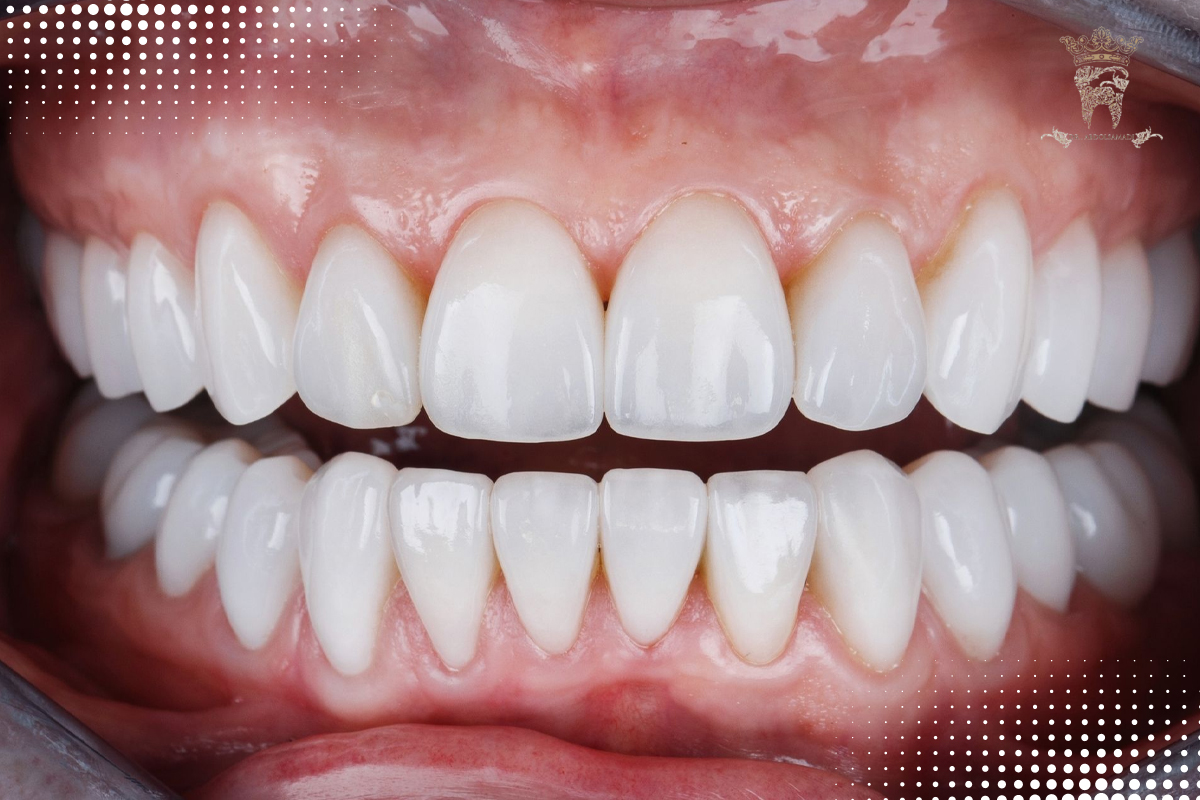 لومینیرز و لمینت دندان: آیا لومینیرز همان لمینت دندان است؟ 1 لمینت دندان