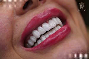 لمینت دندان دیجیتال در تهران | طراحی لبخند دقیق با دکتر عبدالصمدی 10 طراحی لبخند دیجیتال