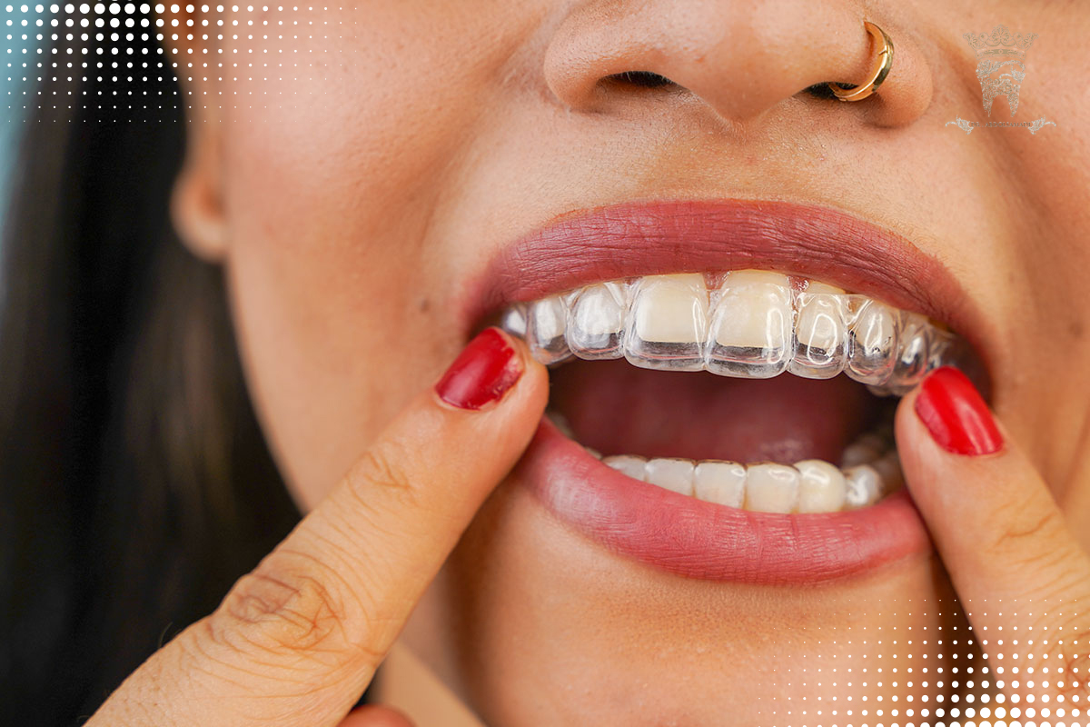 ارتودنسی اینویزلین چیست؟ بررسی مزایا، مراحل و هزینه در تهران 4 عوارض احتمالی ارتودنسی اینویزلین و راههای پیشگیری