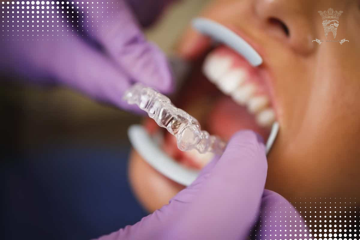 ارتودنسی اینویزلین چیست؟ بررسی مزایا، مراحل و هزینه در تهران 2 مراحل انجام ارتودنسی اینویزلین