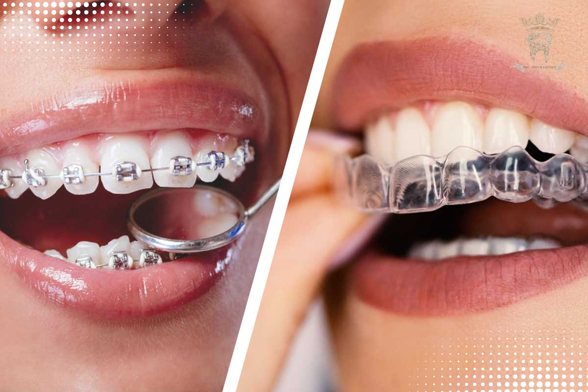 ارتودنسی اینویزلین چیست؟ بررسی مزایا، مراحل و هزینه در تهران 1 تفاوت ارتودنسی اینویزلین با ارتودنسی ثابت سنتی