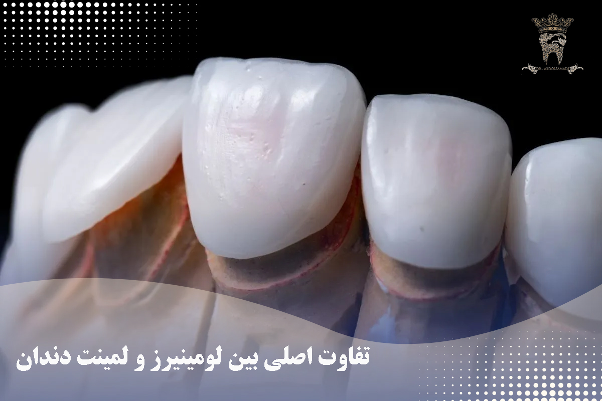 لومینیرز و لمینت دندان: آیا لومینیرز همان لمینت دندان است؟ 2 تفاوت اصلی بین لومینیرز و لمینت دندان