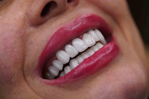 لمینت دندان دیجیتال در تهران | طراحی لبخند دقیق با دکتر عبدالصمدی 4 طراحی لبخند مژگان توکلی