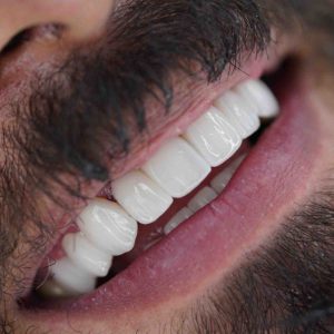 دندانپزشکی زیبایی در تهران: معرفی تخصص و ضرورت آن 3 43298849234