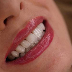 قیمت لمینت دندان 1404 (لمینت دندان در تهران) 8 48932849832