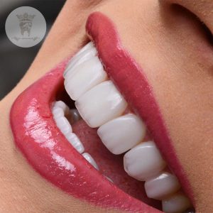 دندانپزشکی زیبایی در تهران: معرفی تخصص و ضرورت آن 4 4932884932