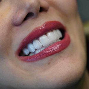 قیمت لمینت دندان 1404 (لمینت دندان در تهران) 6 493289432