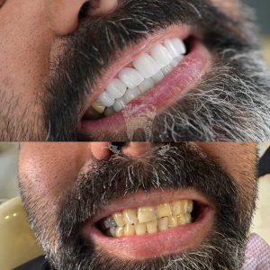 قیمت لمینت دندان 1404 (لمینت دندان در تهران) 12 894382984932