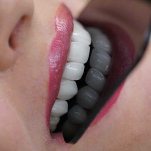لمینت دندان بدون تراش در تهران؛ انتخابی ایدهآل برای اصلاح طرح لبخند 9 9324898342