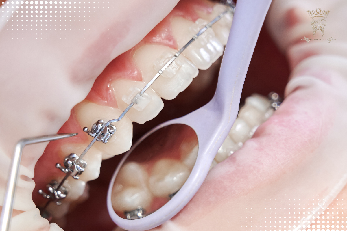 لمینت دندان ارتودنسی راهنمای جامع انتخاب، مزایا، معایب و سن مناسب آن 1 مقایسه عملکرد لمینت و ارتودنسی در درمان مشکلات دندانی