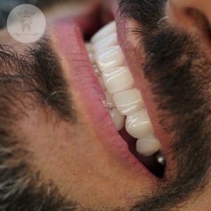 صفر تا صد طراحی لبخند دیجیتال (طرح لبخند) 19 نمونه درمان طراحی لبخند آقای رمضانعلی