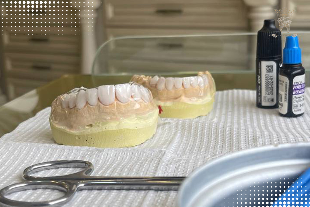 لمینت دندان دیجیتال در تهران | طراحی لبخند دقیق با دکتر عبدالصمدی 3 مواد مورد استفاده در ساخت لمینت دیجیتال