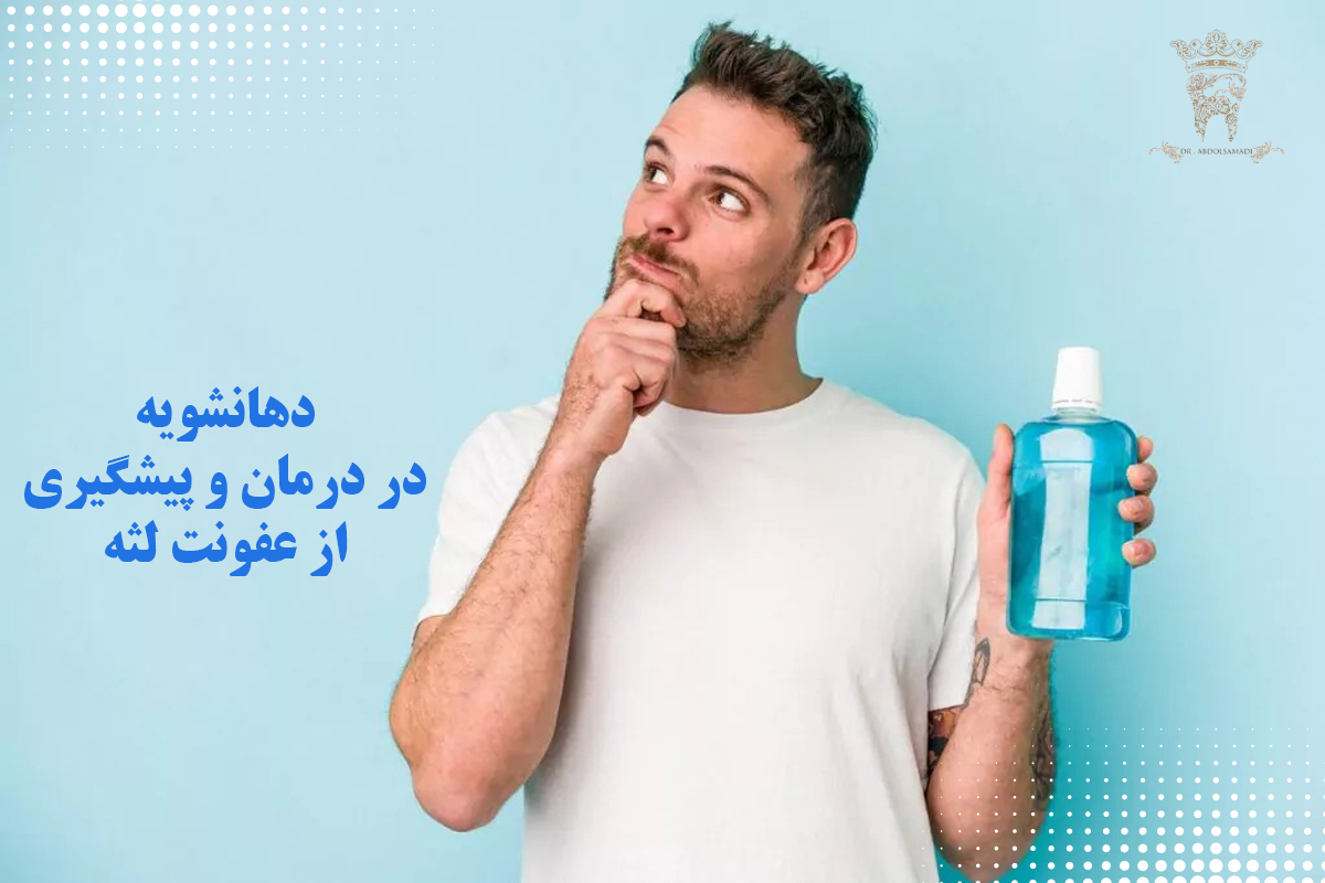 دهانشویه برای عفونت لثه، بهترین دهانشویهها، ترکیبات مؤثر و روش استفاده 1 دهانشویه در درمان و پیشگیری از عفونت لثه