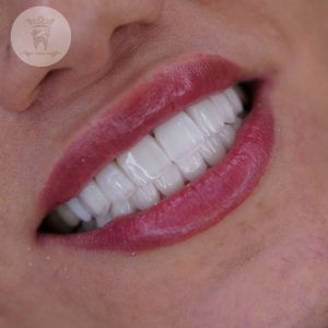 صفر تا صد طراحی لبخند دیجیتال (طرح لبخند) 20 نمونه درمان طراحی لبخند خانم حیدری
