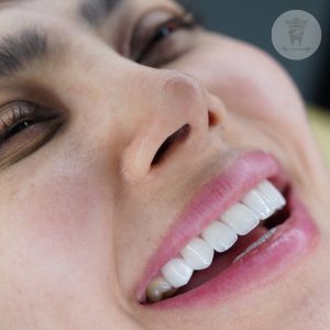صفر تا صد طراحی لبخند دیجیتال (طرح لبخند) 18 بعد کار خام قره چایی لمینت دندان