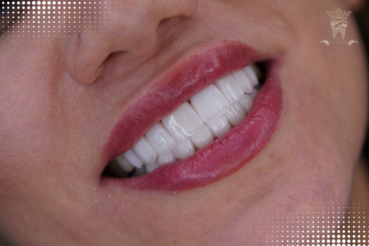 لمینت دندان کامپوزیتی چیست؟ مزایا، کاربرد، مقایسه با لمینت سرامیکی و نکات مراقبتی 2 لمینت دندان سرامیکی