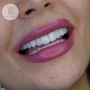همه چیز در مورد لمینت دندان ایمکس (مزایا و معایب لمینت ایمکس) 9 ونیر سرامیکی خانم بهشتی