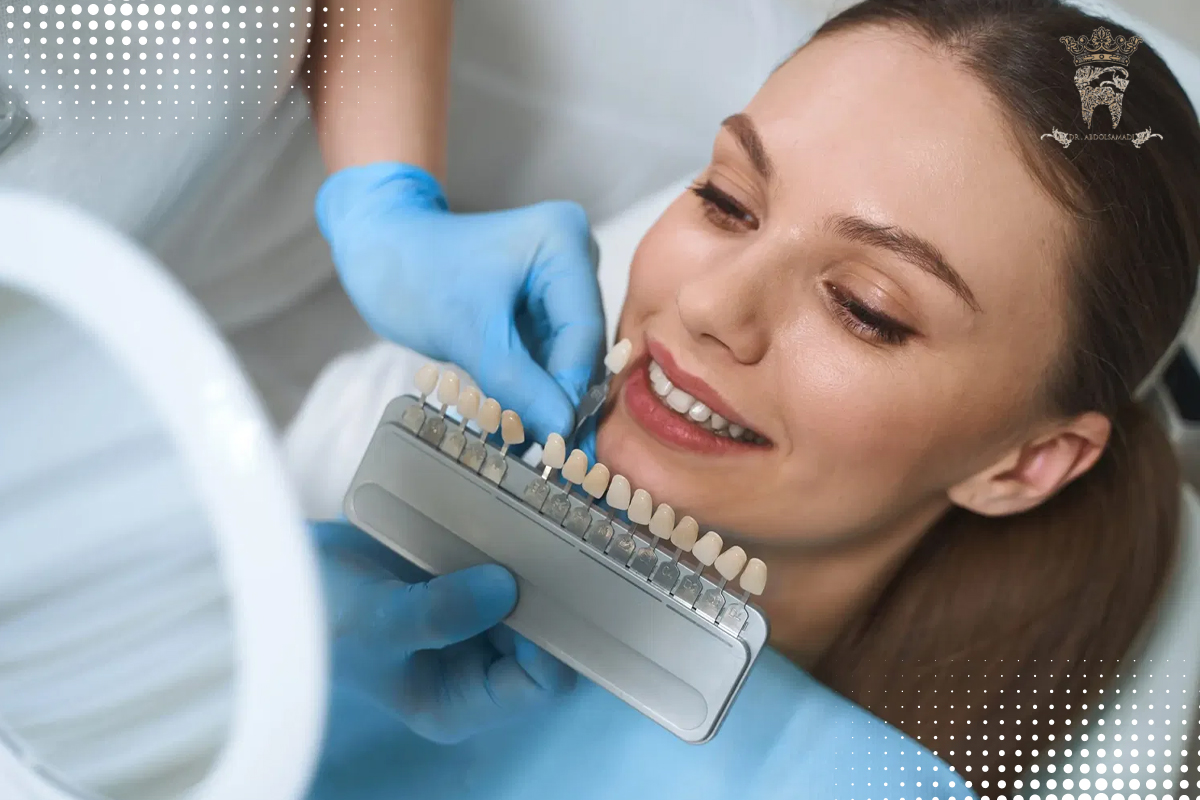 لمینت دندان کامپوزیتی چیست؟ مزایا، کاربرد، مقایسه با لمینت سرامیکی و نکات مراقبتی 4 لمینت دندان کامپوزیتی