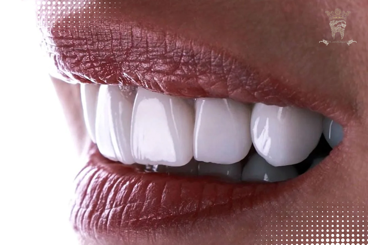 لمینت دندان کامپوزیتی چیست؟ مزایا، کاربرد، مقایسه با لمینت سرامیکی و نکات مراقبتی 1 ویژگیهای کلیدی لمینت دندان کامپوزیتی