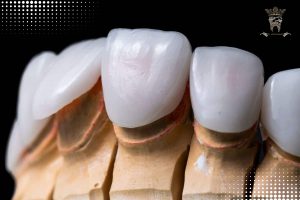 قیمت روکش دندان