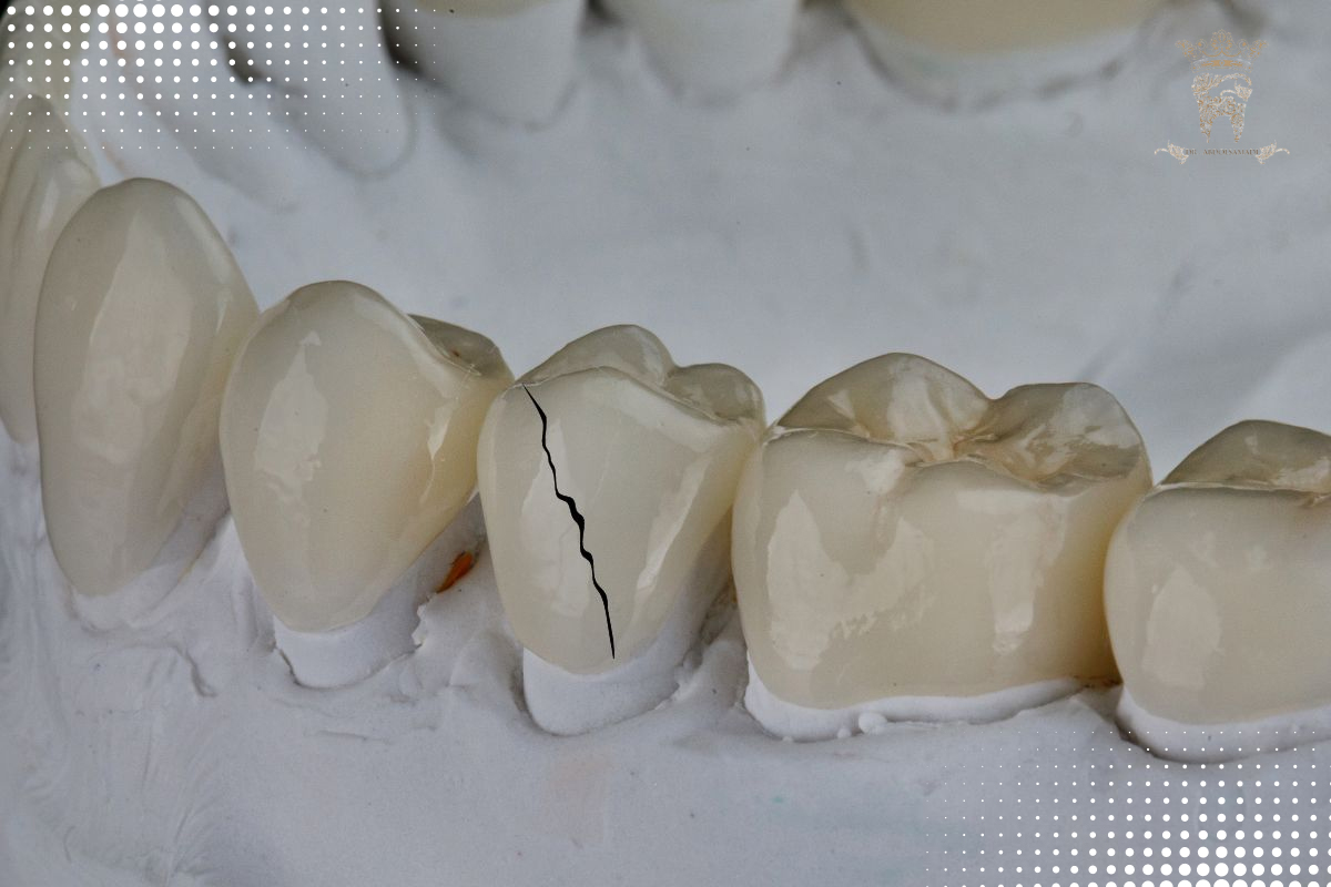 لمینت برای دندان شکسته یا ترک خورده 2 استفاده از لمینت برای دندانهای شکسته