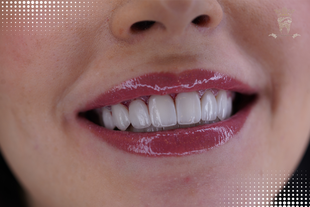 لمینت کانتکت لنز (ونیر سرامیکی کم تراش) 3 تفاوت لمینت و لمینت کانتکت لنز