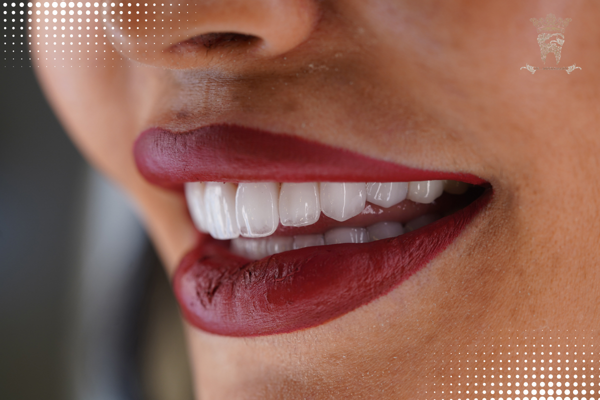 لمینت کانتکت لنز (ونیر سرامیکی کم تراش) 1 تصویر لمینت کانتکت لنز