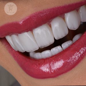 صفر تا صد طراحی لبخند دیجیتال (طرح لبخند) 17 نمونه طراحی لبخند دیجیتال