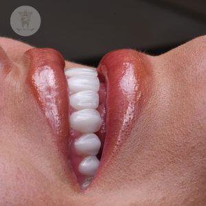 لمینت دندان بدون تراش در تهران؛ انتخابی ایدهآل برای اصلاح طرح لبخند 3 نمونه درمان لمینت کانتکت لنز در تهران