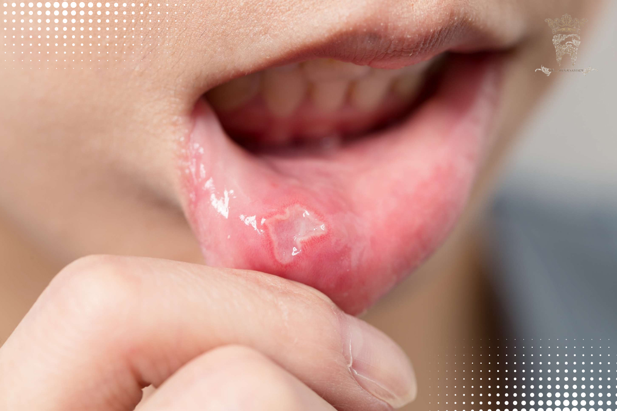 جوش داخل دهان و روشهای درمان آن 14 درمان سریع آفت دهان