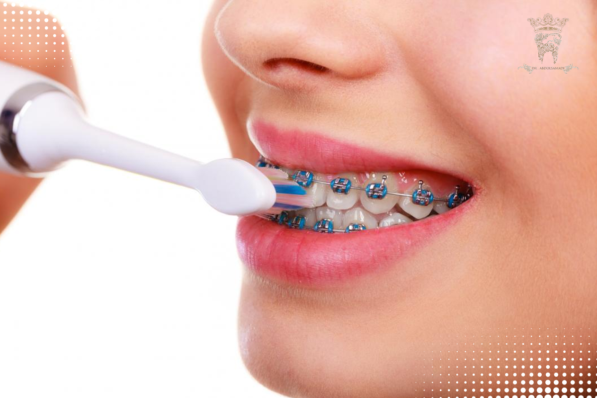 مسواک بین دندانی چیست و چه کاربردی دارد؟ 3 بهترین جایگزین برای مسواک ارتودنسی