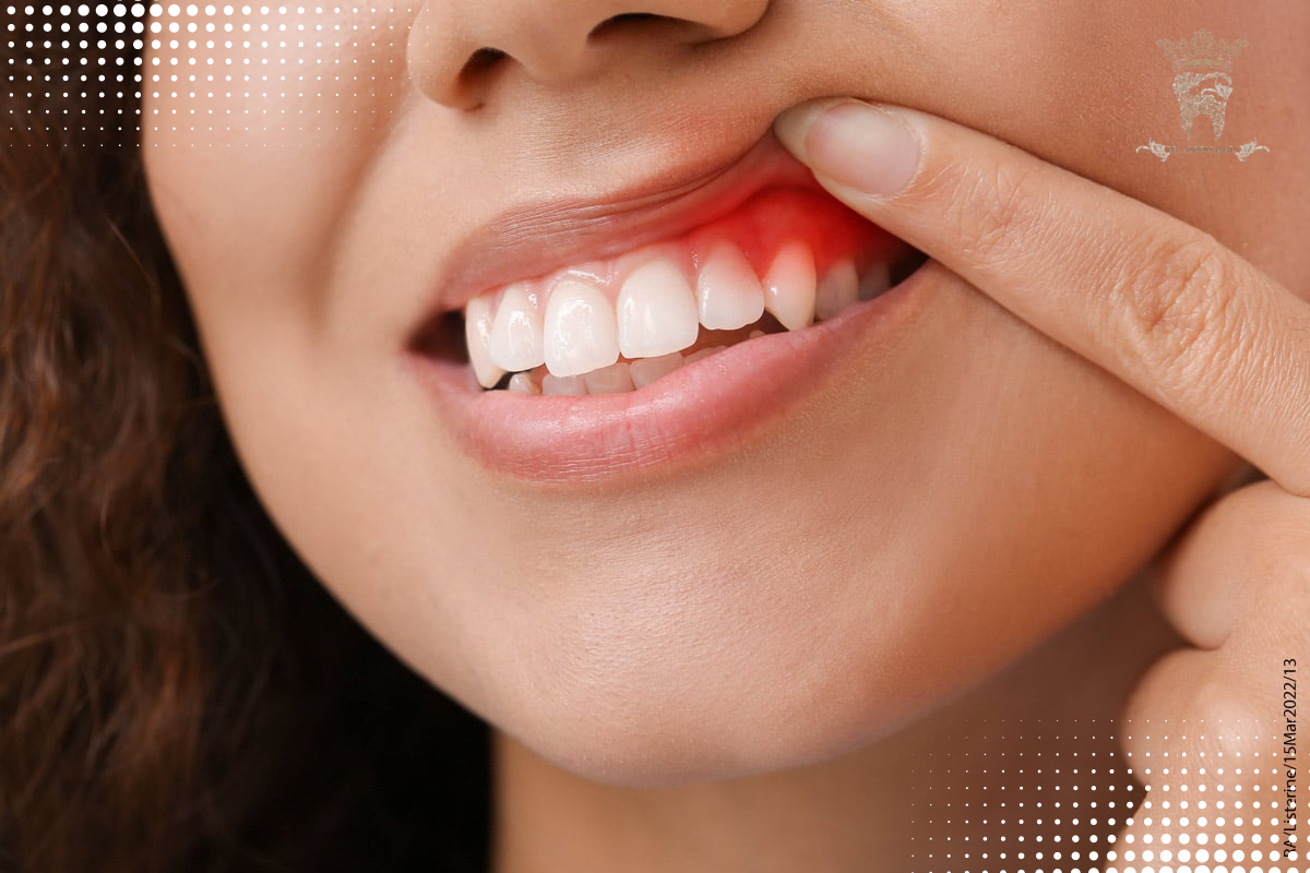 خونریزی لثه هنگام مسواک زدن؛ نشانهای ساده یا هشداری جدی برای سلامت دهان؟ 2 خونریزی لثه