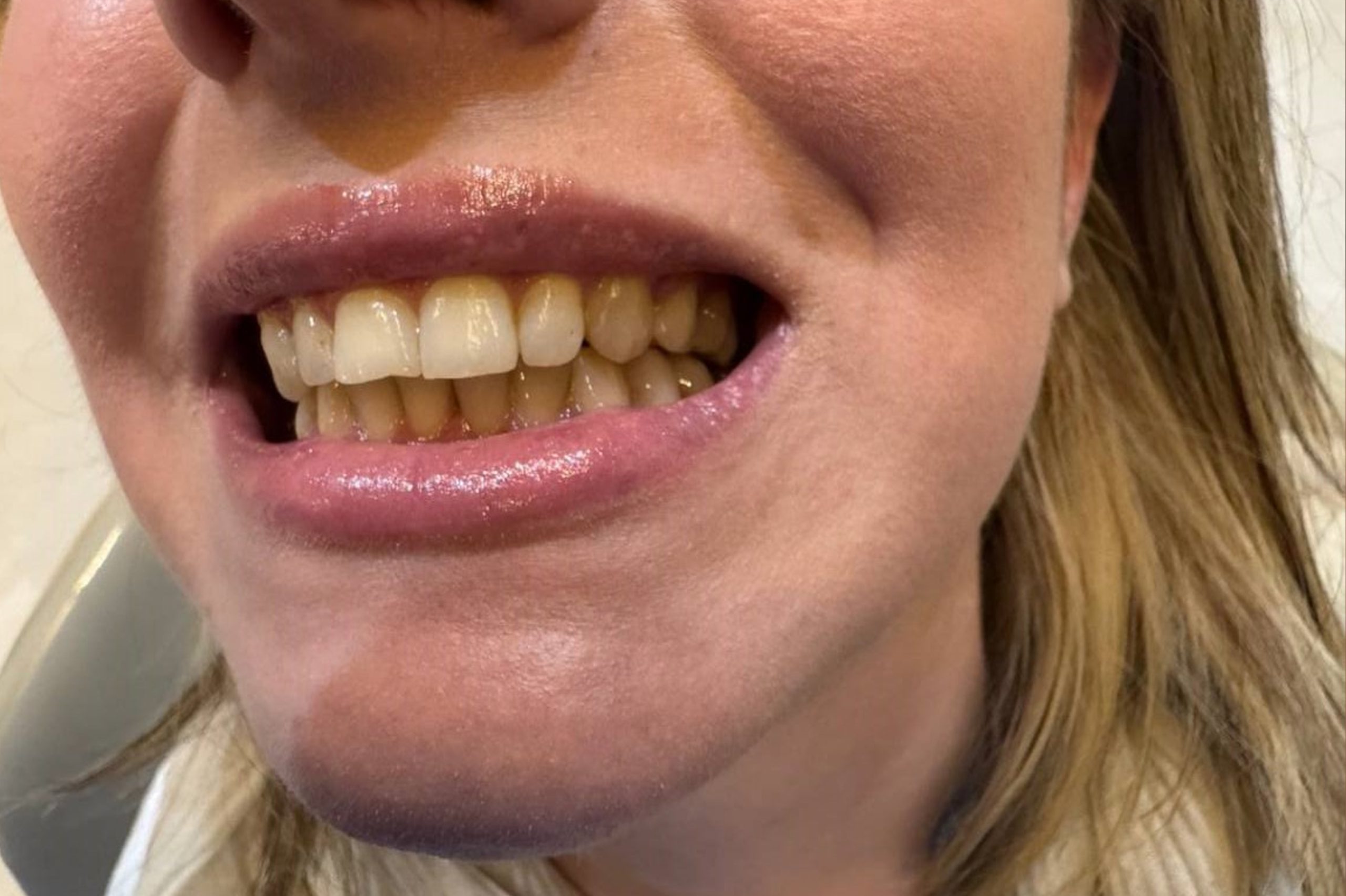 Before-and-after-photos-of-ceramic-veneers-by-Soheila-Faraji-scaled.jpg Before-and-after-photos-of-ceramic-veneers-by-Soheila-Faraji-scaled.jpg